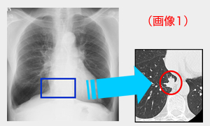 肺の画像１