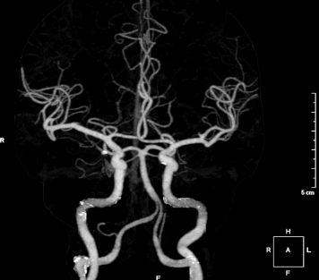 脳3DCT血管造影検査