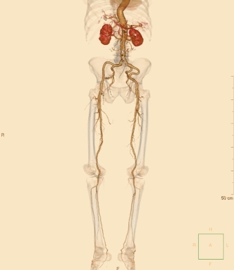 腹部～下肢動脈３DCT造影検査